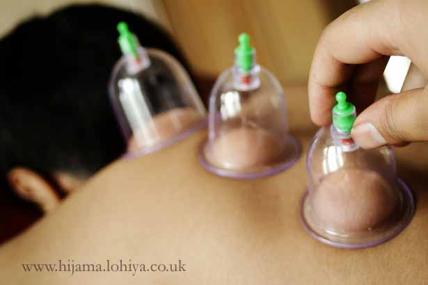 Health Hijama Cupping London Shamim Lohiya