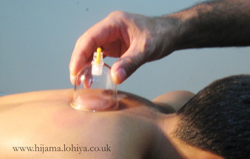 Health Hijama Cupping London Walthamstow E17 Shamim Lohiya