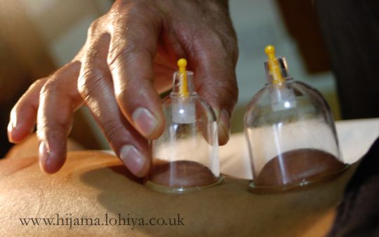 Health Hijama Cupping East London Shamim Lohiya Walthamstow E17