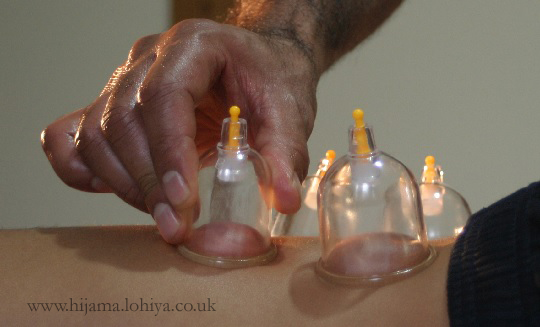 health hijama cupping east london walthamstow e17 4cups