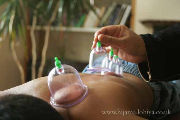 health hijama cupping london