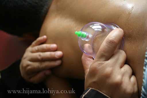 Health Hijama Cupping London Shamim Lohiya