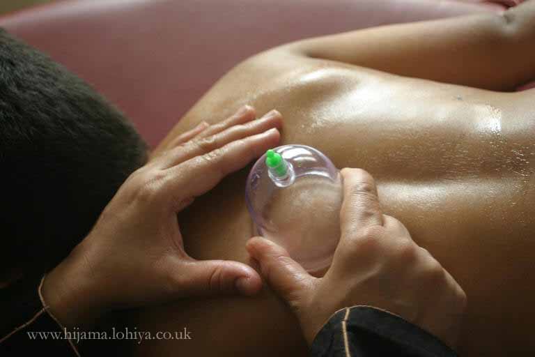 Health Hijama Cupping London Shamim Lohiya