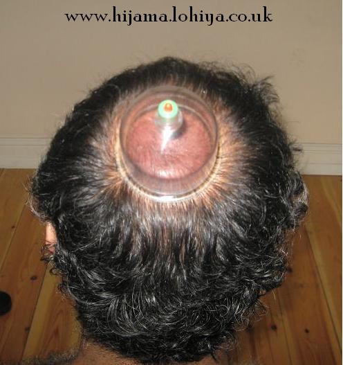 Health Hijama Cupping London Shamim Lohiya